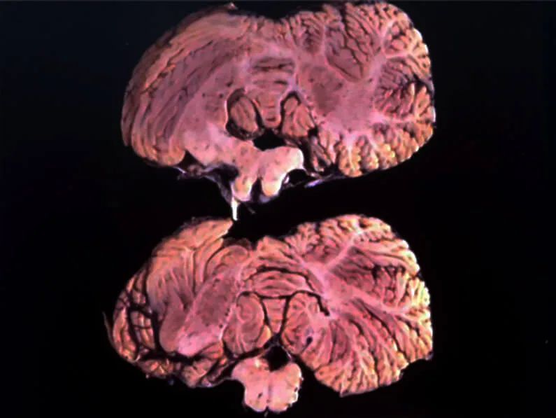 Two cross-sectioned lobes of a Kuru-infected cerebellum showing degenerated, discolored brain tissue